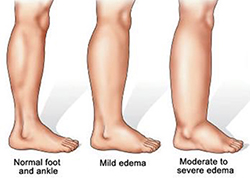 Edema and the elderly